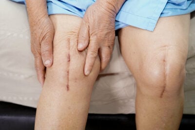 Prepare Your House Before Knee Surgery
